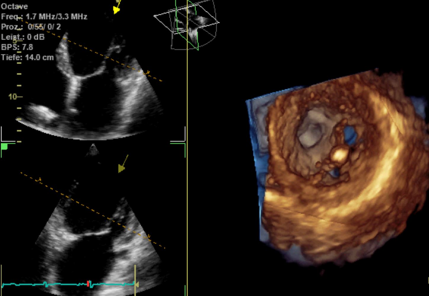Dreidimensionale Echokardiographie-räumliche Darstellung des Herzens in der Aufsicht (hier Mitralklappe mit Mitraclip)