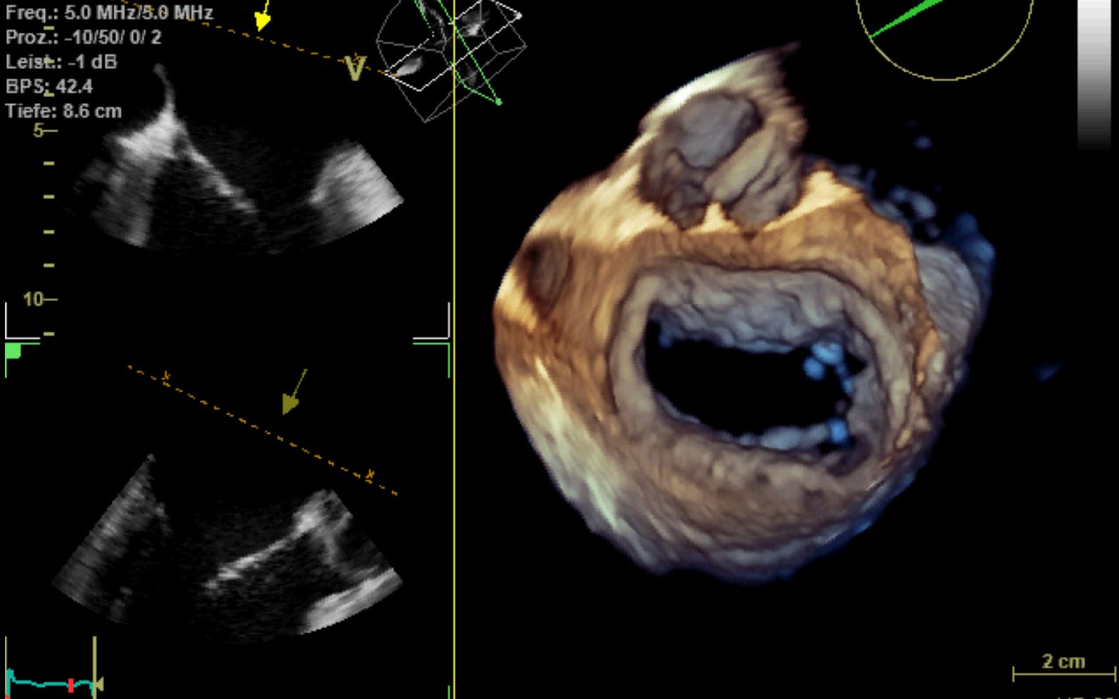 Dreidimensionale Schluckechokardiographie (transösophageale Echokardiographie, TEE)- räumliche Darstellung des Herzens in unterschiedlichen Schnittebenen und in der Aufsicht (hier Mitralklappe geöffnet)