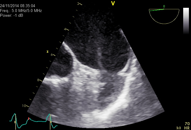 Zweidimensionale Schluckechokardiographie (transösophageale Echokardiographie, TEE)-Darstellung des Herzens (hier linkes Herzohr) in hoher Auflösung
