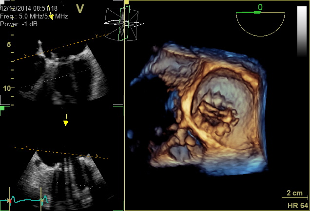 Dreidimensionale Schluckechokardiographie (transösophageale Echokardiographie, TEE)-räumliche Darstellung des Herzens in unterschiedlichen Schnittebenen und in der Aufsicht (hier Mitralklappenersatz mit künstlicher Herzklappe)